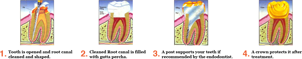 Painless root canal procedure